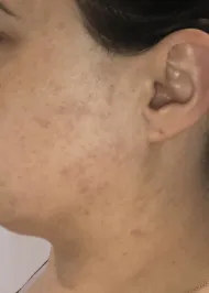 woman with acne before